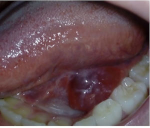 Tumefacción con contenido líquido en la base de la lengua.
