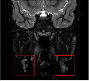 Aspecto multiquístico de las glándulas parótidas en la resonancia magnética.