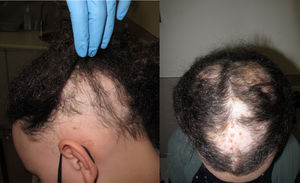 Situación antes del inicio de tratamiento con tofacitinib: alopecia areata total (herramienta de gravedad de la alopecia, SALT, de 30). Evolución posterior a alopecia universal. Situación antes del inicio de tratamiento con tofacitinib: alopecia areata total (herramienta de gravedad de la alopecia, SALT, de 30). Evolución posterior a alopecia universal.