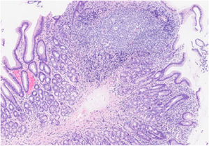 Gastritis crónica activa de patrón folicular en mucosa de antro (tinción H&E, ×10).