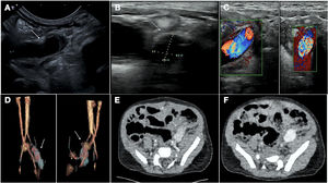A-C) Ecografía Doppler vascular que muestra seudoaneurisma en proyección longitudinal (20mm) y transversal (14×10mm) con flujo turbulento en su interior. D-F) Imágenes de la angio-TAC que confirman el seudoaneurisma dependiente de la arteria ilíaca interna izquierda con permeabilidad de los vasos distales.