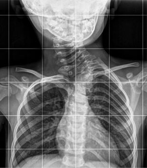 En esta imagen se puede observar un defecto vertebral con hemivértebra C7 derecha, fusiones vertebrales a nivel de C7-T1 y anomalías costales derechas que ocasionan una escoliosis dorso-cervical izquierda de carácter congénito con sospecha de origen genético.