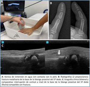 Ecografía clínica para la detección de fracturas de dedos de la mano.