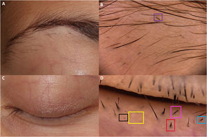 A y B) Hipotricosis de la ceja e imagen dermatoscópica correspondiente. C y D) Hipotricosis de la pestaña e imagen tricoscópica de la misma paciente.
