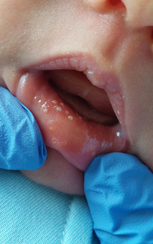 Gránulos de Fordyce en el labio inferior. Gránulos de Fordyce en el labio inferior.