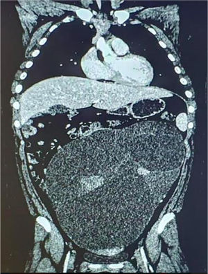 Corte coronal de TAC: tumoración quística multilocular trabeculada de 34×25×16cm. Corte coronal de TAC: tumoración quística multilocular trabeculada de 34×25×16cm.