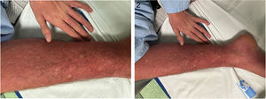 Petequias generalizadas y exantema eritematoso con zonas blanquecinas intercaladas conocido como signo de «islas blancas sobre mar rojo». Petequias generalizadas y exantema eritematoso con zonas blanquecinas intercaladas conocido como signo de «islas blancas sobre mar rojo».