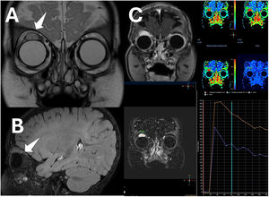 Imágenes de resonancia magnética. En plano coronal (A) y sagital (B) se observa lesión homogénea hiperintensa en T2 en la parte distal del recto superior del ojo derecho, cerca de la inserción ocular, de 16×14×16mm (diámetros ap×tr×cc), con un borde hipointenso correspondiente a una pseudocápsula, con una difusión facilitada y sin calcificación ni hemorragia dentro de la lesión. C. Se realizó estudio de contraste dinámico, donde se adquirieron imágenes T1 con supresión grasa, observándose una curva arterial/tipo 3 que muestra un rápido ascenso inicial, seguido de un descenso con el tiempo (washout) en la fase retardada. La imagen poscontraste en el músculo recto superior izquierdo muestra un realce homogéneo.