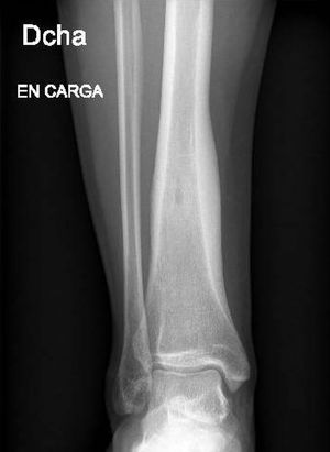 Radiografía anteroposterior en carga del tobillo derecho. Se aprecia lesión cortical puntiforme en tercio distal de tibia derecha con reacción cortical perilesional.