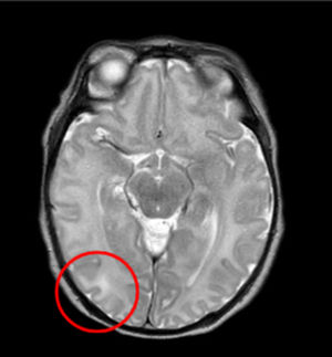Resonancia magnética cerebral de la paciente realizada durante su ingreso en secuencia T2. Se resalta en rojo el área de hiperseñal en la sustancia blanca subcortical.