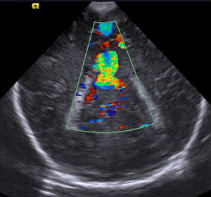 Ecografía Doppler color transcraneal de la fístula de alto flujo.