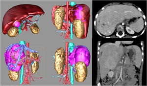 Paciente mujer de 6años con hepatocarcinoma pretextIII. Reconstrucciones 3D y volumetría hepática prequirúrgicas. Fuente: cortesía de la Dra. Ana Coma, Servicio de Radiología Pediátrica, Hospital Vall d’Hebron.