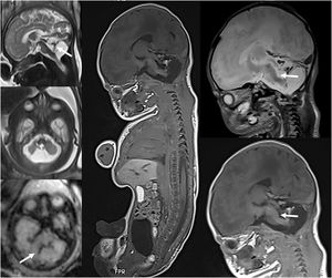 Feto de 33 semanas de gestación con hallazgo ecográfico de hipoplasia cerebelosa. A)RM fetal realizada a las 33 semanas, que demuestra una lesión clástica o destructiva del cerebelo con restos hemorrágicos (flechas). B)RM fetal post mortem tras la interrupción de la gestación que muestra la hemorragia cerebelosa, con hallazgo asociado de lesión tegmental del bulbo raquídeo (flechas), no evidenciada previamente.