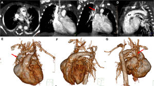 Imágenes de tomografía computarizada del caso2. A-G)Arteria pulmonar izquierda (API) con origen en el tronco de la arteria pulmonar (AP). D-G)Ductus arterioso persistente (DAP) que comunica la arteria pulmonar con la aorta descendente (AoD). E-G)Reconstrucciones tridimensionales que muestran el origen anómalo de la APD desde la aorta ascendente (AoA) y la interrupción del arco aórtico. C,E,G)Arteria pulmonar derecha (APD) pequeña (flecha roja) con origen en la aorta ascendente (AoA).