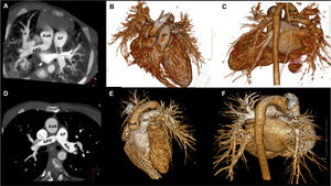 Imágenes de tomografía computarizada del caso4. A)Arteria pulmonar izquierda (API) con origen en el tronco de la arteria pulmonar (AP). Arteria pulmonar derecha (APD) con origen en la aorta ascendente (AoA). B-C)Reconstrucciones tridimensionales. D-F)TC de control tras la intervención quirúrgica.