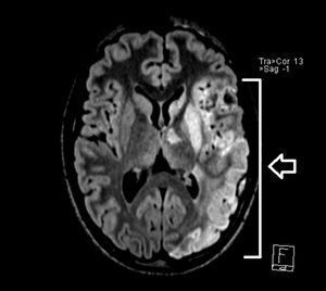 Reconstrucción 3D de secuencia FLAIR axial que muestra la extensión del accidente cerebrovascular isquémico (flecha blanca).