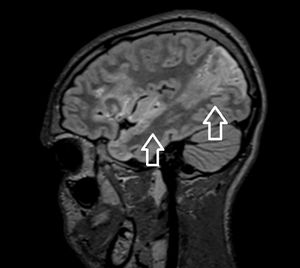 Reconstrucción 3D de secuencia FLAIR sagital que muestra la extensión del accidente cerebrovascular isquémico (flechas blancas).
