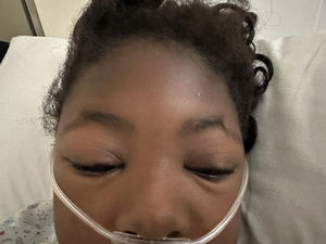 Tumefacción periocular en la paciente descrita.