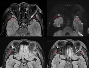 Múltiples cortes transversales de RMN cerebral con los hallazgos descritos indicados mediante flechas rojas.
