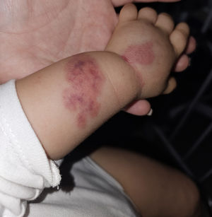 Edema en extremidad superior que afecta al brazo y al antebrazo, asociado a lesiones purpúricas.