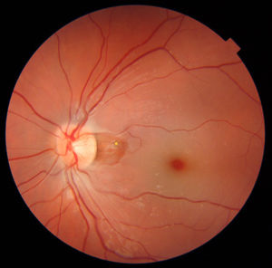 Fundoscopia. Aspecto del fondo del ojo en la oclusión de la arteria central de la retina, con palidez retiniana y signo de mancha rojo cereza. Se preserva la circulación de la arteria ciliorretiniana, con color normal de la retina (estrella naranja) en comparación con la retina isquémica. No se observaron embolismos en el árbol vascular.