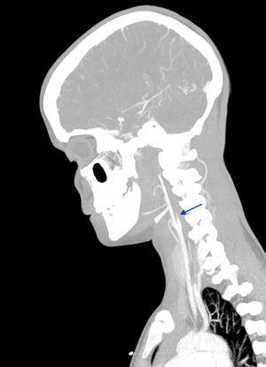 Angiotomografía computarizada. Interrupción de la perfusión de contraste en el territorio de la arteria carótida interna secundaria a la disección, dando lugar a la imagen característica en «punta de lápiz» (flecha azul).