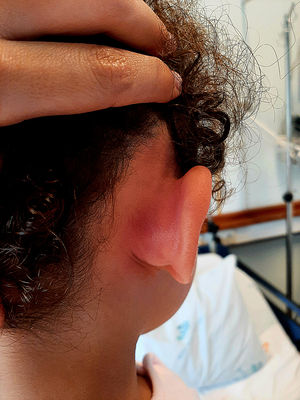 Signos inflamatorios en la zona retroauricular y protrusión auricular.