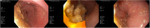 Endoscopia digestiva alta: esófago dilatado con importante retención de alimento.