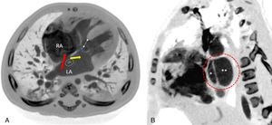(A) Angiotomografía computarizada. Proyección axial que revela la coexistencia infrecuente de canal auriculoventricular completo y cor triatriatum, mostrando el defecto tipo ostium primum (flecha doble azul) y la comunicación interventricular (flecha doble blanca). La parte superior de la aurícula izquierda (AI) se comunica con la aurícula derecha (AD) a través de una comunicación interauricular (flecha roja). La flecha amarilla indica la comunicación entre las partes superior e inferior de la AI dividida. Por último, la elipse blanca delimita la membrana del cor triatriatum (también en proyección axial). (B) El círculo rojo discontinuo en la proyección sagital delimita la AI dividida, con el asterisco (*) indicando la parte ventral/inferior y el doble asterisco (**) la parte dorsal/superior.
