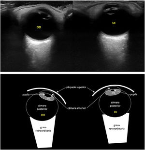 En las imágenes superiores (Obl) se observa el ojo derecho en midriasis ante la privación lumínica directa y consensual; y el ojo izquierdo, en miosis en situaciones similares, lo que pone de manifiesto la ausencia del reflejo fotomotor, sugestivo de inflamación de la cámara anterior (uveítis anterior). En las figuras inferiores se esquematizan cada una de las imágenes superiores.
