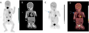 A, imagen MIP; B, imagen coronal TC; C, imagen coronal PET; D, imagen coronal fusión PET/TC: 18F-FDG mostró un foco de aumento de la captación del radiofármaco (flecha azul) en la región epifisaria proximal del húmero derecho en relación con osteomielitis activa2, y captación de intensidad moderada en la superficie articular de la cabeza humeral derecha en relación con el ya conocido proceso articular activo.