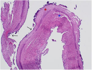 Corte histológico de esófago proximal (tinción hematoxilina-eosina, x4 aumentos). Podemos observar capa superficial descamada compuesta de material paraqueratósico con necrosis coagulativa (estrella roja), así como la separación entre la mucosa viable y necrótica (estrella azul). Las flechas muestran las bacterias adheridas a la superficie de la mucosa. No se observan inclusiones víricas ni organismos fúngicos. El número de eosinófilos intraepiteliales era <15 por campo en todas las biopsias.