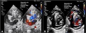 A y B. Ecocardiograma transtorácico en proyección apical 4 cámaras (A) y paraesternal eje corto (B) de control tras un año del procedimiento con defecto ligero residual. VD: ventrículo derecho; VI: ventrículo izquierdo.