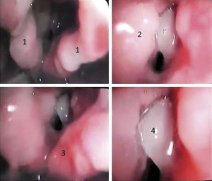 1) Áreas ulceroaftosas en ambos repliegues aritenoepiglóticos; 2) área fibrinosa en banda izquierda y ulcerativa contralateral; 3) área ulcerativa en espacio interaritenoideo; 4) vesícula que abarca completamente la cuerda vocal derecha.