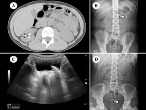 Diferentes modalidades de imagen y localizaciones de los cálculos. Se muestra una tomografía con 2 litiasis renales (A, flecha), una litiasis renal izquierda en una radiografía de abdomen (B, flecha), también una cistolitiasis en ecografía (C) y un cálculo ureteral distal (D, flecha).