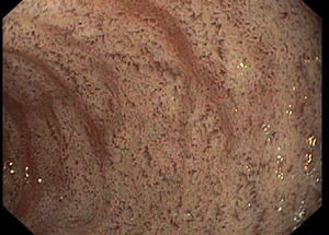 Imagen endoscópica de la segunda porción duodenal: aspecto blanquecino de la mucosa.