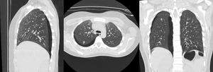 Tomografía computada de tórax: neumotórax derecho, laceración pulmonar del lóbulo inferior derecho.