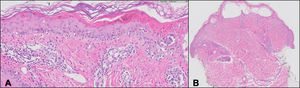 A) Desprendimiento dermoepidérmico con vesiculación y necrosis de toda la epidermis (magnificación ×20×). B) Dermatitis de interfase con vacuolización basal y queratinocitos apoptóticos (magnificación ×1).