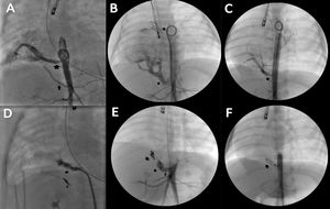 Angiografías pre y post oclusión de los vasos nutricios del secuestro pulmonar. A, B, C) Aortograma basales de casos 1, 2 y 3. Se aprecia indicados por flechas los vasos nutricios que se originan de la aorta e irrigan el secuestro pulmonar. D, E, F) Angiografías post oclusión de los vasos nutricios de los casos 1, 2 y 3. Indicándose con flechas los dispositivos implantados.