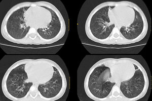 Tomografía computarizada pulmonar con atelectasias y bronquiectasias en lóbulo medio y língula.