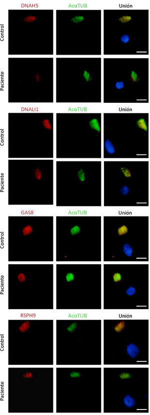 Análisis de inmunofluorescencia de las proteínas del axonema ciliar en una muestra de epitelio ciliado respiratorio de la paciente y en una muestra control. Localización subcelular de proteínas en el axonema ciliar DNAH5, DNALI1, GAS8 y RSPH9 (en rojo), y α-tubulina acetilada (AcαTUB, en verde). La tercera columna muestra la imagen conjunta con el núcleo marcado con DAPI (en azul). DNAH5 está ausente en el axonema ciliar de la muestra de la paciente comparando con el control. Escala bar, 5μm.