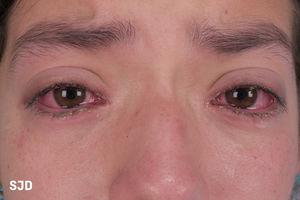 Hiperemia conjuntival.