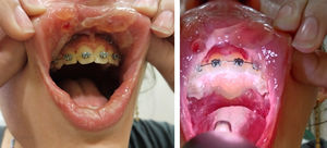 Mucositis oral.