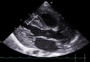 Ecocardiografía en plano paraesternal largo en la que se objetiva engrosamiento del tabique interventricular (5,5mm).