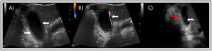 Ecografía abdominal. A)Cambios inflamatorios-edematosos de la pared vesicular con engrosamiento difuso parietal (flechas blancas). B)Marcado aumento de la vascularización doppler (flecha blanca). C)Imágenes puntiformes en el interior vesicular correspondiente a «barro espeso» (flecha blanca) y edema de grasa perivesicular (flecha roja).