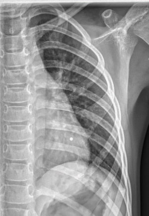 Radiografía de tórax en proyección anteroposterior. Se aprecia en parrilla costal izquierda bifurcación de la cuarta costilla.