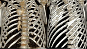 Reconstrucción 3D de tomografía computarizada de tórax; se objetiva costilla bífida a nivel del cuarto arco costal izquierdo.