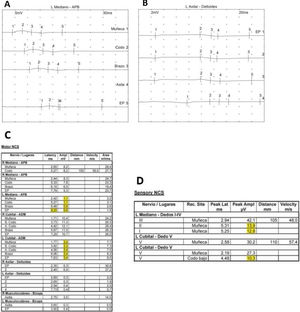 C)A nivel motor se estudian parámetros de conducción motora del nervio axilar (B), musculocutáneo, mediano (A) y cubital bilateralmente, estimulando en Erb, brazo, codo y muñeca, y registrando en músculos deltoides, bíceps, abductor corto del pulgar y abductor del Vdedo. Se obtiene un potencial de latencia distal normal y amplitud muy descendida en abductor corto y abductor del dedoV izquierdos, con retraso de la respuesta estimulando en Erb para el mediano. D)A nivel sensitivo se estudia el componente sensitivo del mediano izquierdo a nivel de dedoIII, y cubital izquierdo a nivel de dedoV. Se obtienen valores de amplitud reducidos normales al estimular distalmente en muñeca, que se reducen significativamente al estimular en codo (la degeneración axonal ha llegado al codo, pero no a la muñeca). Los hallazgos electrofisiológicos mostrados son compatibles con una panplexopatía braquial izquierda aguda con afectación predominante de tronco superior y axonotmesis de los nervios mediano y cubital distal.