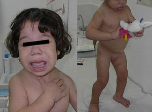 Rasgos fenotípicos de la niña: pérdida de la cola de la ceja, edema facial, macroglosia, distensión abdominal, hernia umbilical.