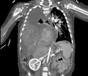 TAC toracoabdominal.